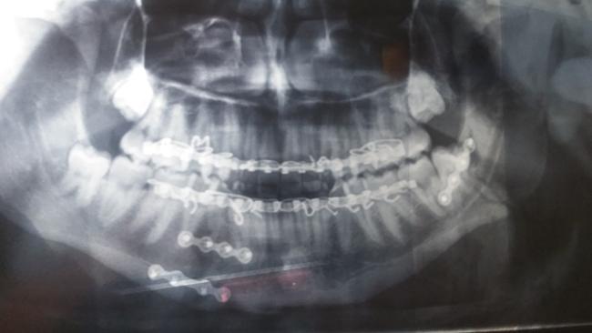 X-ray of Ryan Holman's badly broken jaw showing the metal screws and wires he's had inserted after he was assaulted by Iliesa Cama. Picture: Facebook