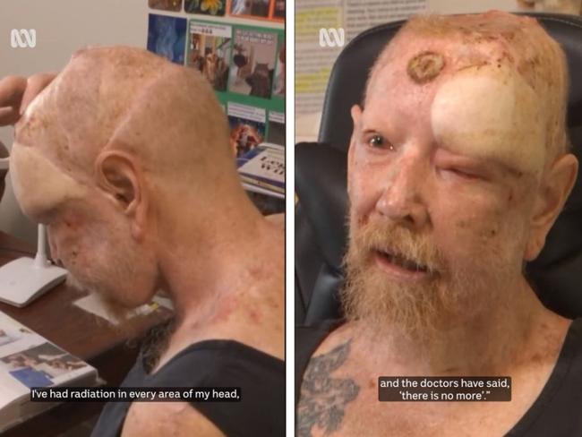 Victorian man Leigh Raaschou, who has worked outside most of his life and “never wore a hat,” has had almost 200 skin cancers removed.