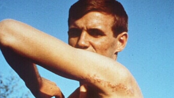 Rodney Fox shows his scars.