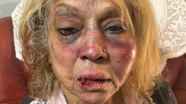 Ninette Simons received severe facial bruising and swelling after she was allegedly assaulted during a shocking home invasion at her Girrawheen home earlier this month. Picture: WA Police/Supplied