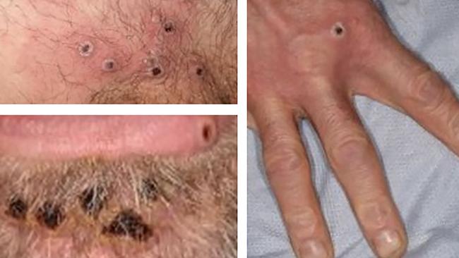 A collage of monkeypox rash lesions. Picture: UK Health Security Agency / AFP