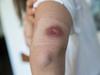 Cause of flesh-eating ulcer finally confirmed
