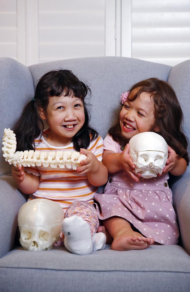 Sisters Maddy (left) and Briella Luk show off the 3D printouts of their spines and skulls. Picture: Sam Ruttyn