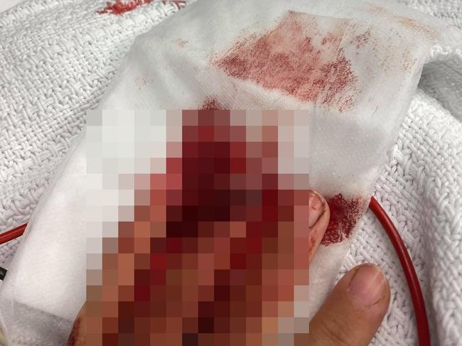 The woman’s finger was partially amputated. Picture: Supplied