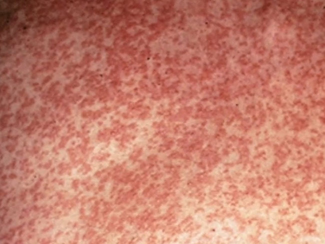 Measles rash. Picture: Supplied