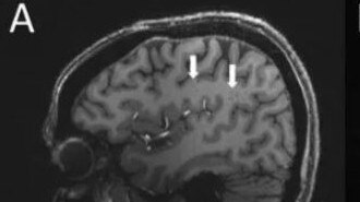 The image shows a brain with a migraine, with the arrows pointing to where the hypertension is. Picture: Radiological Society of North America