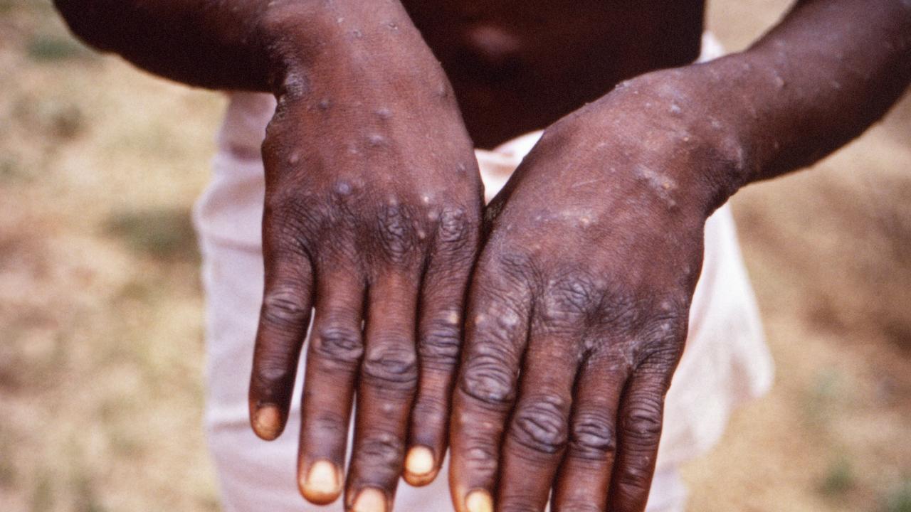 The monkeypox virus has spread to 15 countries outside of Africa