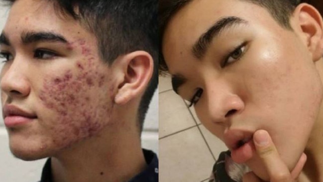 Skincare: The $22 skin treatment product that cured teen’s severe acne