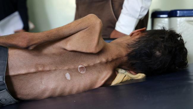 Yemeni boy Ghazi Ali bin Ali, 10, suffering from severe malnutrition, at a hospital in Jabal Habashi. Picture: AFP