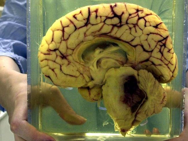 MAR 08, 2001 : A brain from the Westmead Children's Hospital Museum in /Sydney, PicAlanPryke. NSW / Medical human organs body parts