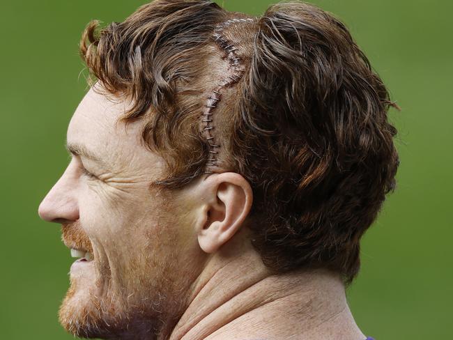 NCA. MELBOURNE, AUSTRALIA. September 16 , 2024. Geelong training at GMNBA Stadium, Geelong.  Gary Rohan of the Cats with a head full of staples after operation to fix a fracture in his skull  during todays session   . Pic: Michael Klein