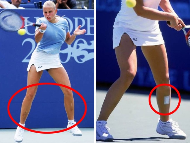 Jelena Dokic’s images show her “swollen, bruised and bleeding shins” (red circles added). Photo: Instagram