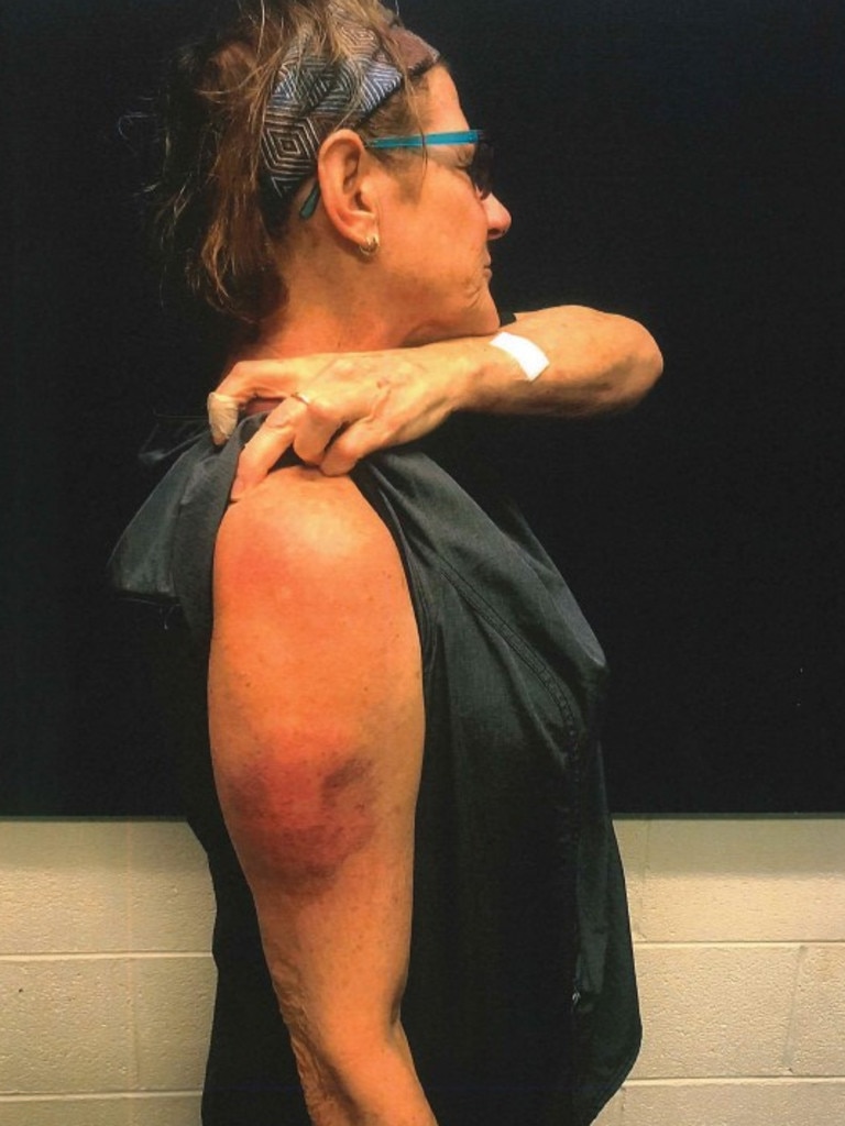 An injury Lorraine Walcott suffered after being struck by a rock. Picture: Courts NT