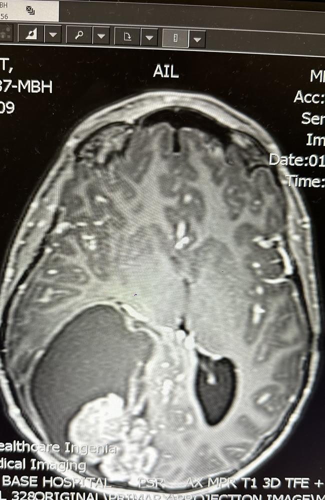 Doctors at Townsville Hospital have removed a tumour and cyst the size of a tennis ball in 13-year-old Jett Dow's brain. Picture: Supplied