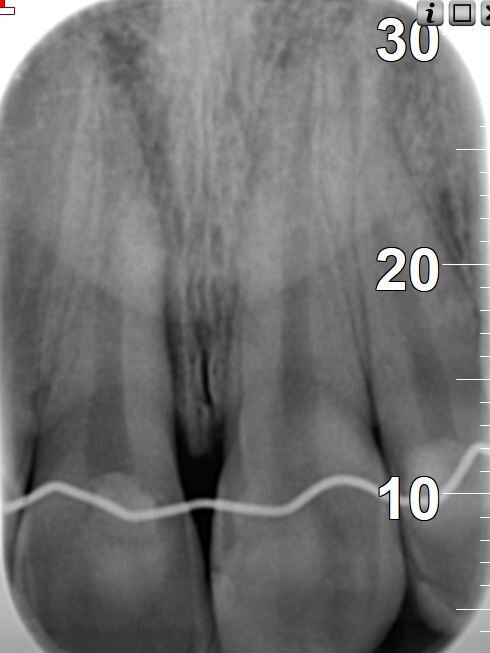 Jessica had to undergo three root canals after the incident. However, has been told she will need extensive work later in life following the injury. Picture: Supplied.