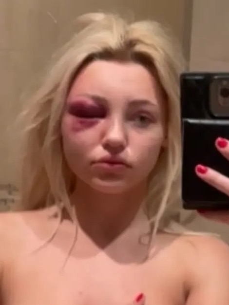 Ms Sias’ claimed in a bombshell lawsuit she was unrecognisable after one particularly bad beating. Picture: Courtesy New York Post