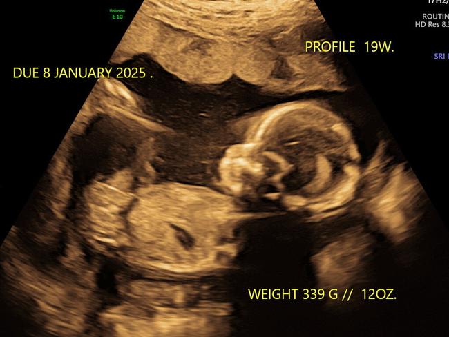 A scan of Jess and Matt Reed’s baby daughter, who is due in January.