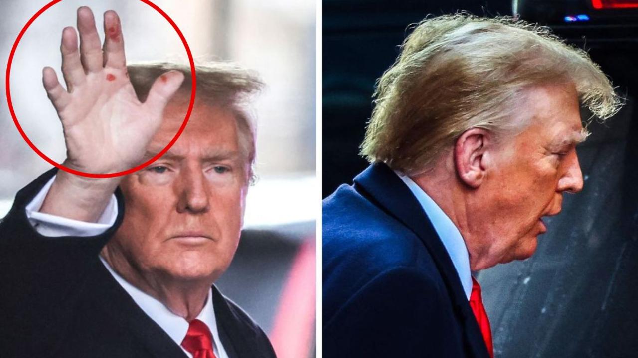 Red spots on Donald Trump’s hand cause revealed | Daily Telegraph