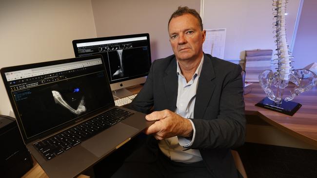 Orthopaedic surgeon Leo Donnan with X-rays of patient Xavier’s damaged and deformed leg. Picture: Alex Coppel.