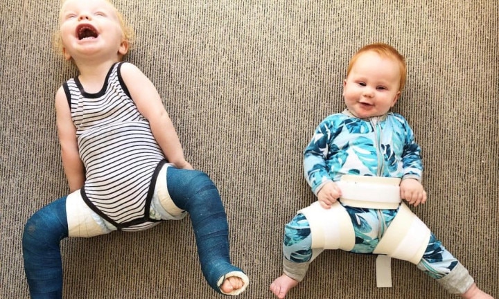 hip dysplasia baby