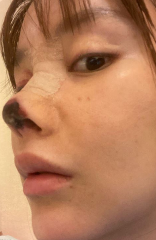 The failed surgery resulted in Gao Liu's nose tissues dying. Picture: Sina Weibo