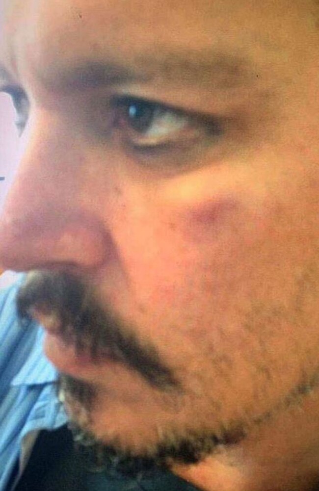 Depp was seen with a bruised face in a picture from 2015. Picture: Fairfax County Court