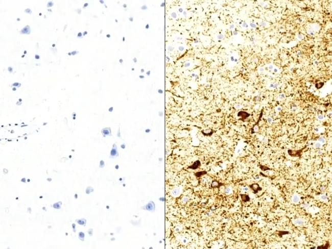 These are tissue samples - a healthy brain on the left, the right Keith's with brown CTE lesions. Photo: Channel 9