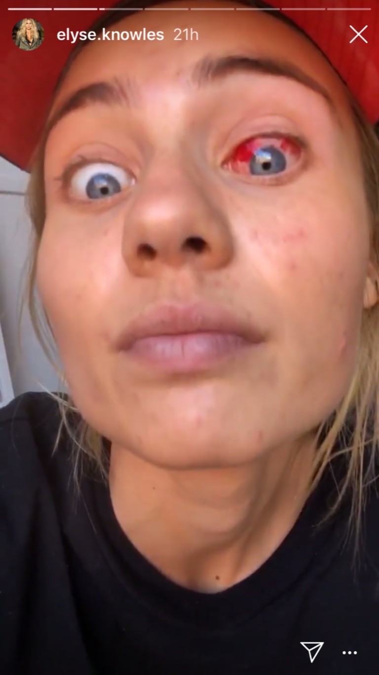 Elyse Knowles shows off the injury to her eye.