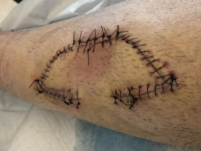 Jason Clare had 52 stitches for his surgery.