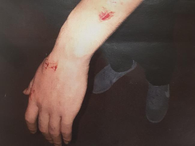 Police photograph tendered to the Adelaide Magistrates Court showing injuries sustained to Gouger St Nice Fish Chinese Restaurant waiter Fan Chi Kong in June, 2017. Chunping Quan is on trial accused of causing those injuries. Picture: SA Police