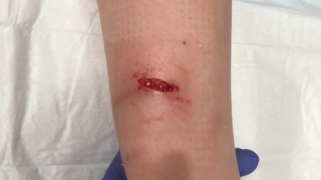 A gash on the leg of Ellie Meek who was attacked by a Maltese cross in Gilpin Park.