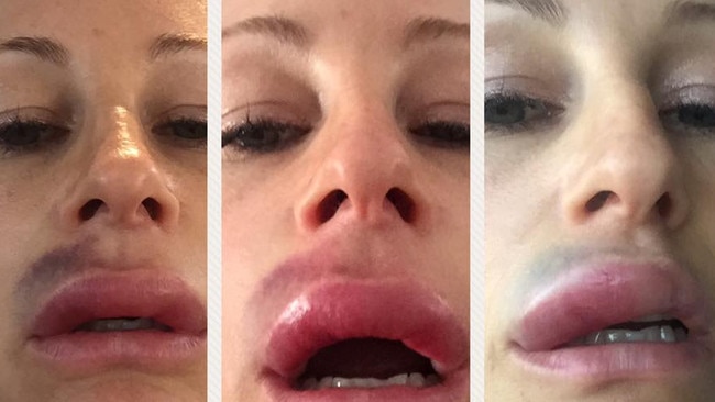 Kristine McCarthy had lip fillers which went wrong 