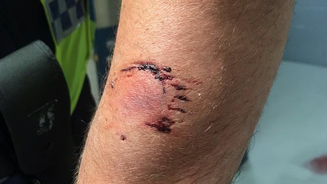 The injuries of a male police officer who was bitten on the arm during an arrest in Gagebrook. Picture: POLICE ASSOCIATION OF TASMANIA