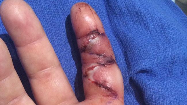 Chef, Amy Russell had a nasty experience after being bit by a feral cat. close up of finger after incident.