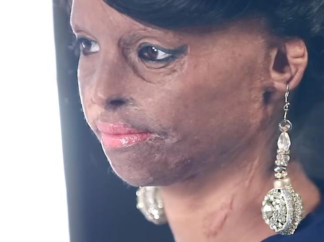 Inspiring ... Laxmi Saa wants to encourage acid attack survivors to stay strong.