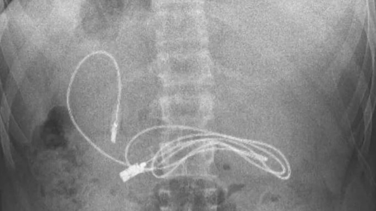Lekarze znajdują kabel ładujący USB w żołądku chłopca