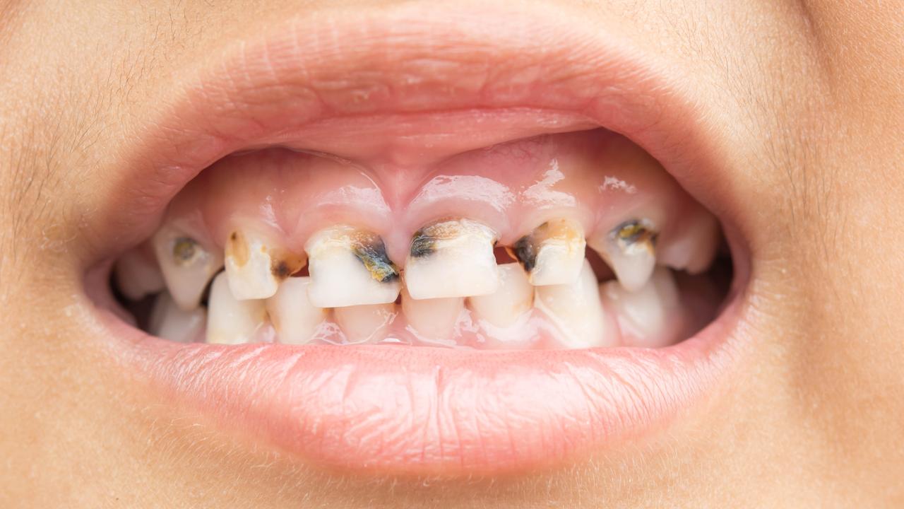 Eating too many of the wrong foods can lead to tooth decay. Picture: iStock