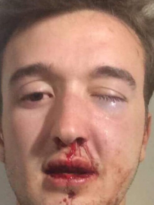 He now has a metal plate in the right side of his face. Picture: Facebook/Andrew McNab