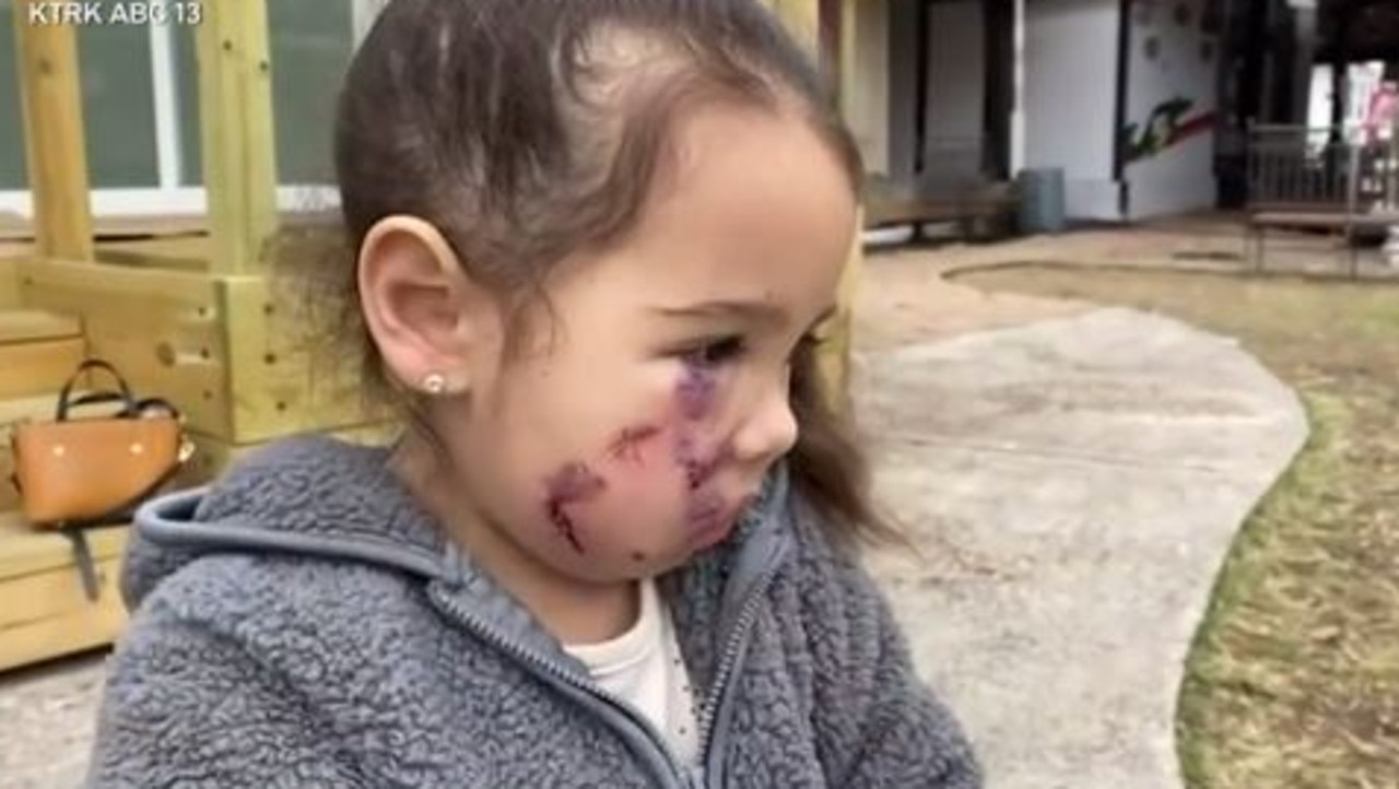 Dog Attack: Toddler Has Face Ripped Open By Pit Bull At Restaurant ...