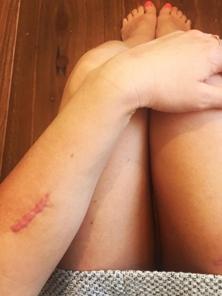 She shared photos of her injuries on social media. Picture: Instagram.