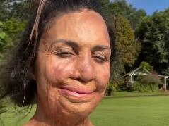 Turia Pitt has opened up about finding photos taken just two days after she received her injuries. Picture: Instagram