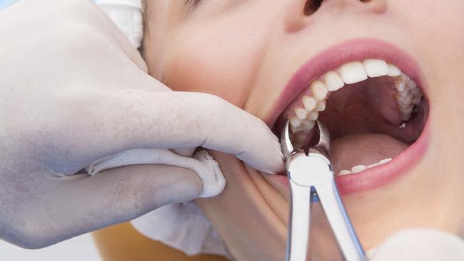 Young woman having tooth removed. Close up picture of a woman mouth with a dentist hand holding extraction forceps