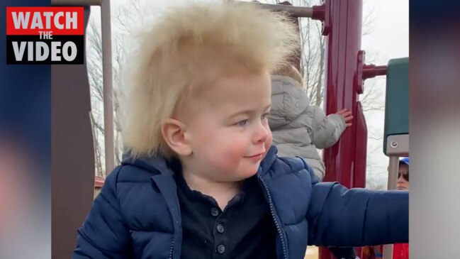 After baby goes viral, expert explains uncombable hair syndrome