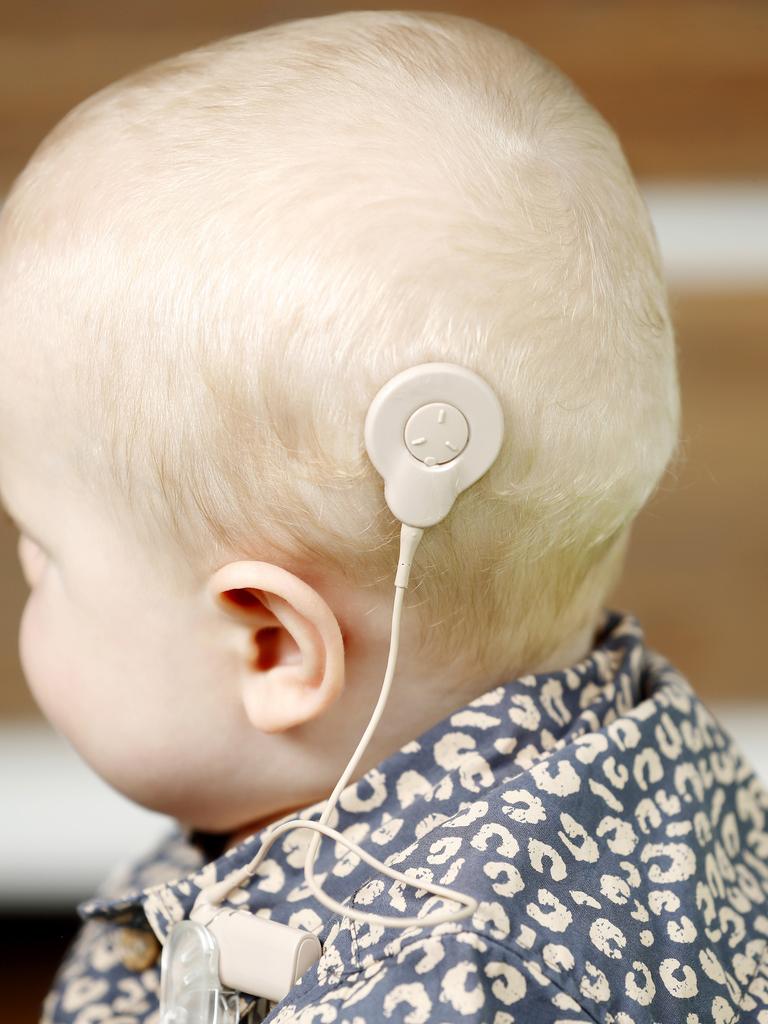 An infant fitted with a cochlear implant.