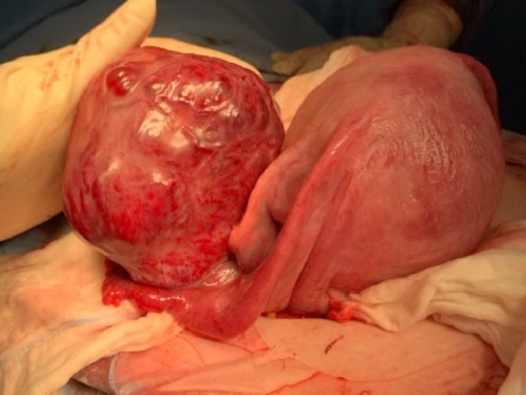 Mater Mothers' Hospital doctors removing the tumour. Picture: Supplied.