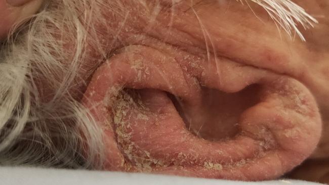 An image appearing to show European scabies on Heather Adey’s ear. Picture: Supplied