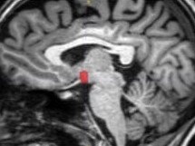 A brain scan showing the smaller hypothalamus in red. Picture: Study author and Radiological Society of North America