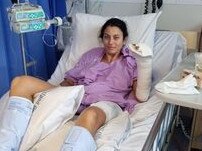 ‘Skinned alive’: Woman’s horrific claims after kitchen burns