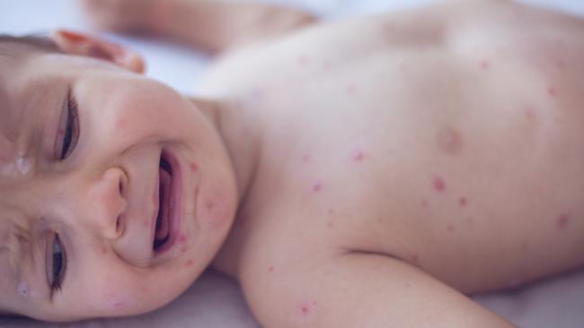 People can be infectious for several weeks before measles’ telltale red spots appear. Picture: istock 