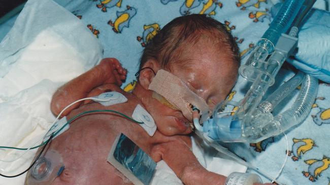 Peter McDonald and his twin brother were born premature.